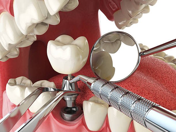 Best Emergency Treatment for Dental Infections or Abscesses in Seneca Knolls, NY
